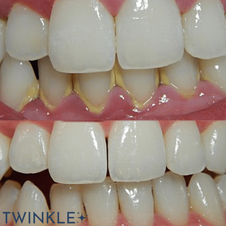 TWINKLE TEETH© - ULTRASONIC TOOTH CLEANER 2.0