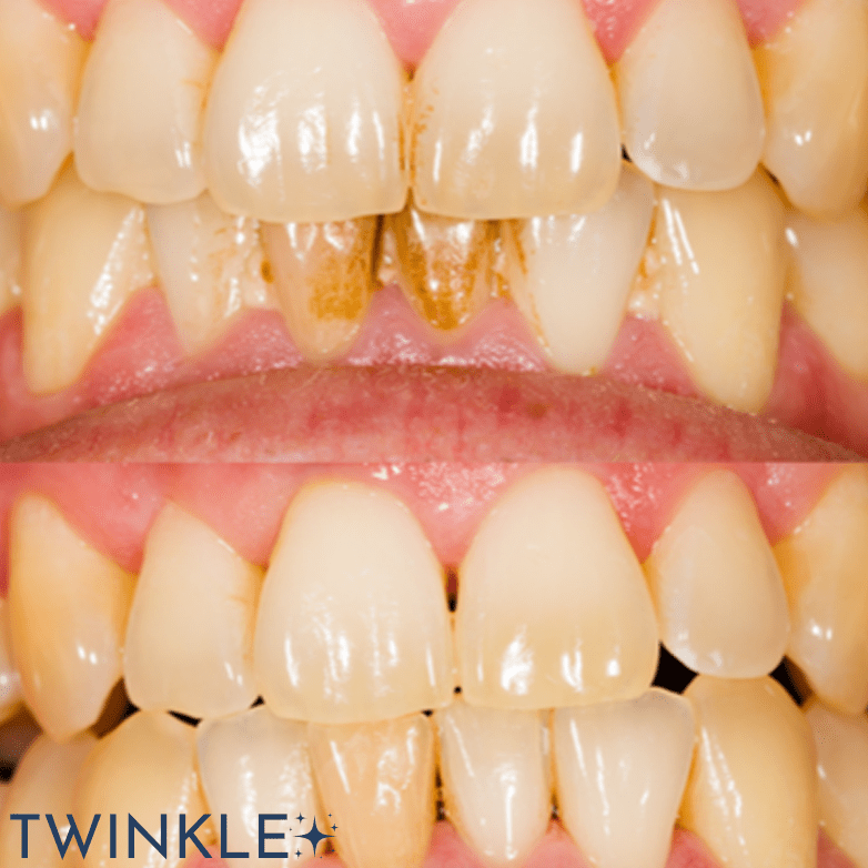 TWINKLE TEETH© - ULTRASONIC TOOTH CLEANER 2.0