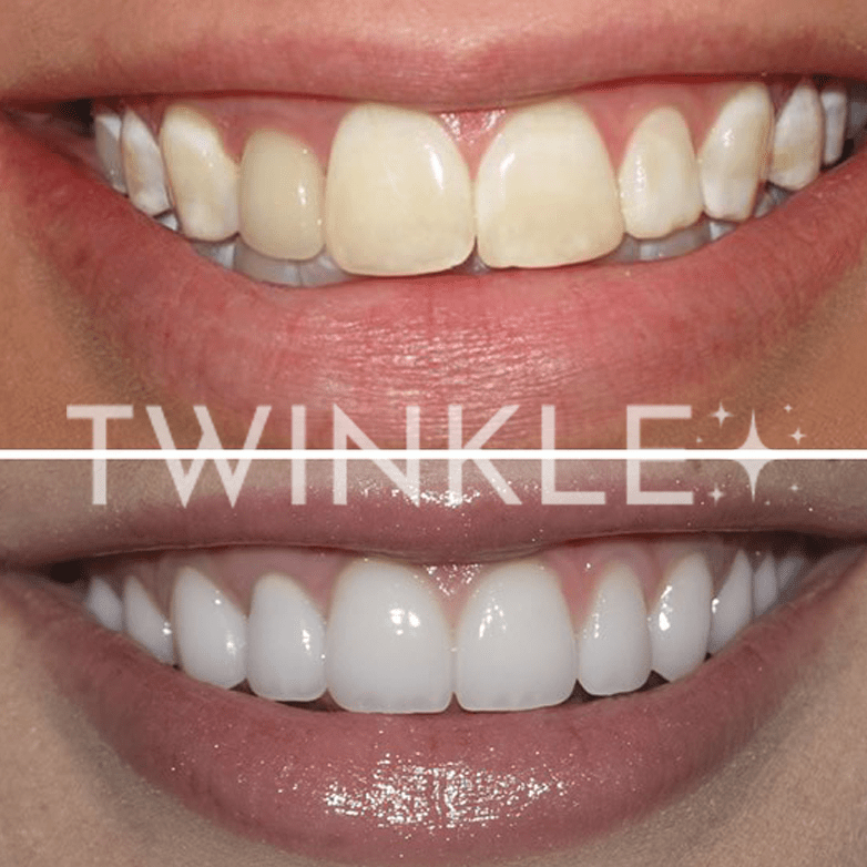 TWINKLE TEETH© - ACTIVATED CHARCOAL DENTAL FLOSS