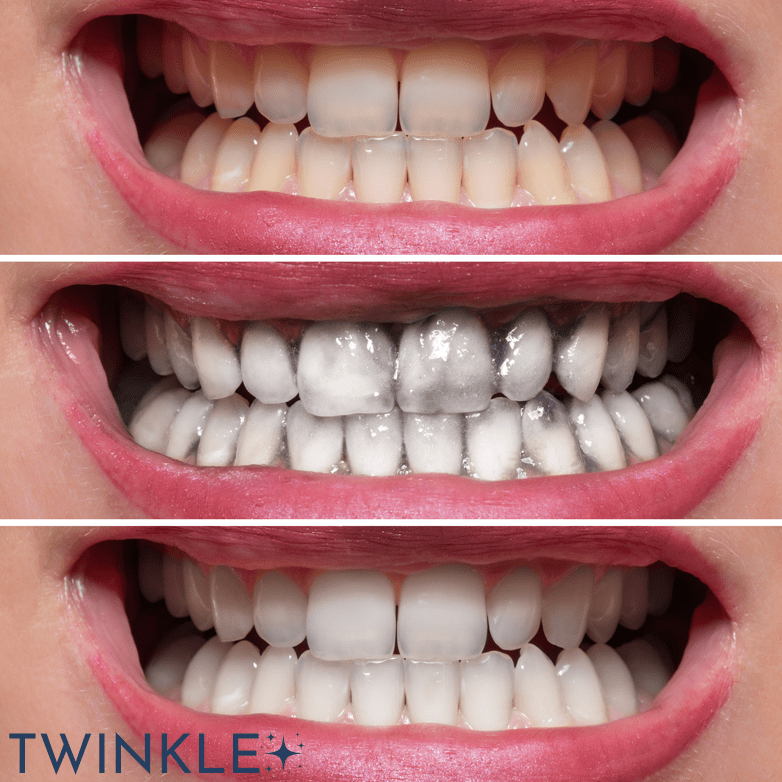 TWINKLE TEETH© - ACTIVATED CHARCOAL TOOTH POLISH